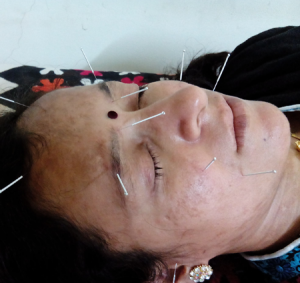 acupuncture treatment in pune