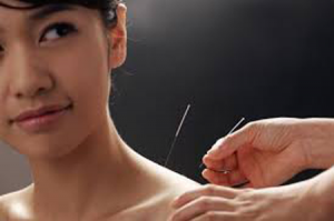acupuncture treatment in pune