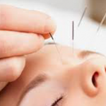 acupuncture treatment in pune