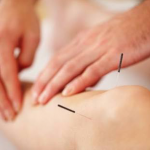 acupuncture treatment in pune