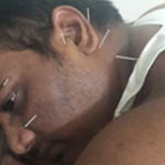 acupuncture treatment in pune