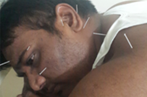acupuncture treatment in pune