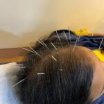 acupuncture treatment in pune