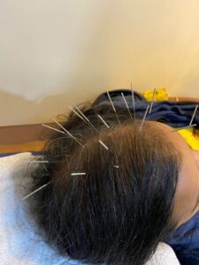 acupuncture treatment in pune